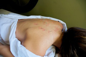 Acupuncture